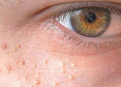 11 روش درمان خانگی و دارویی میلیا (جوش های سفید زیر پوستی) 11 روش درمان خانگی و دارویی میلیا (جوش های سفید زیر پوستی)